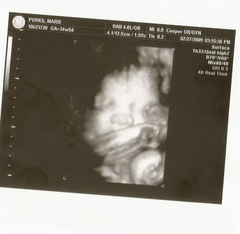 3d ultrasound pictures at 12 weeks. 3d ultrasound pictures at 12